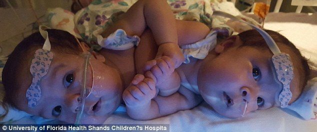 Вчені вперше успішно розділили сіамських близнюків з одним серцем та печінкою (ФОТО)
