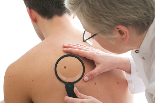 Франківців обстежать на наявність меланом та раку шкіри